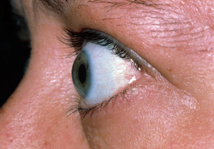 Bulging, Dry Eyes Could Mean Thyroid Eye Disease