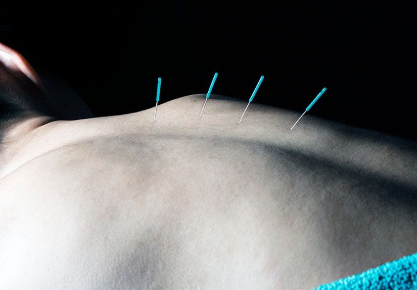 Dry Needling vs. Acupuncture: Benefits and Uses