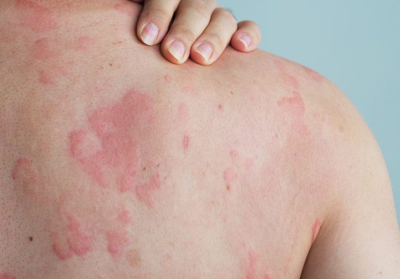 Autoimmune Hives: Causes, Symptoms, Treatments, and More