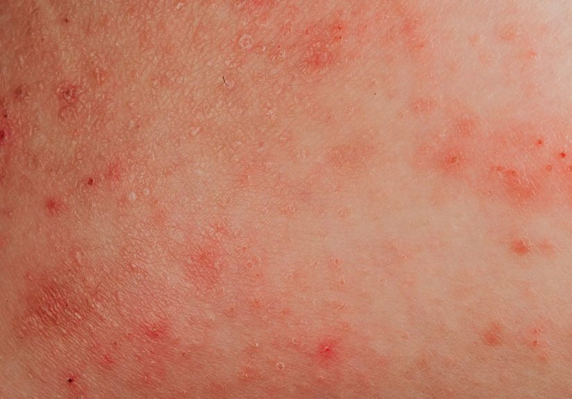 Common Rashes: Types, Symptoms, Treatments, & More