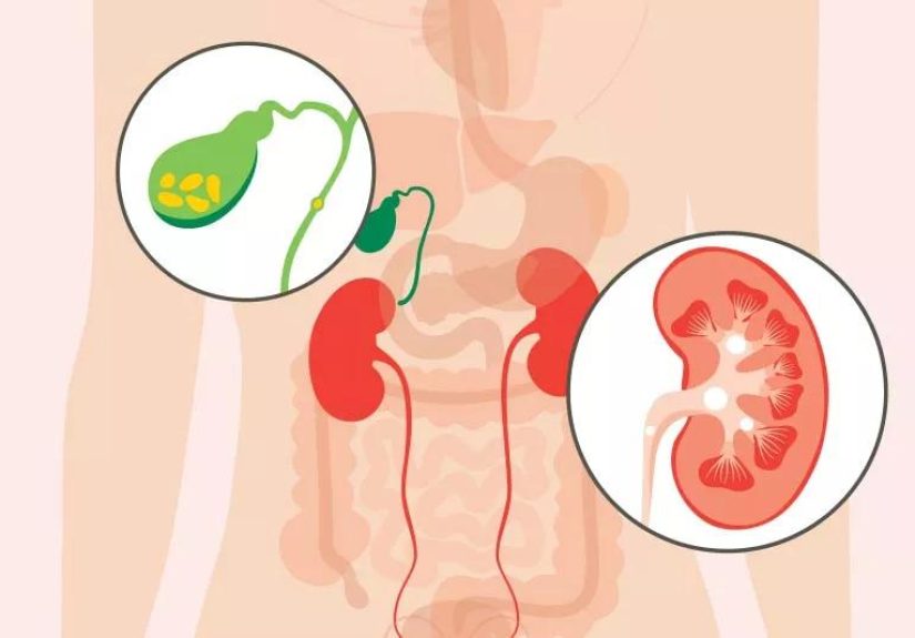 Gallbladder and Kidney Stone Differences