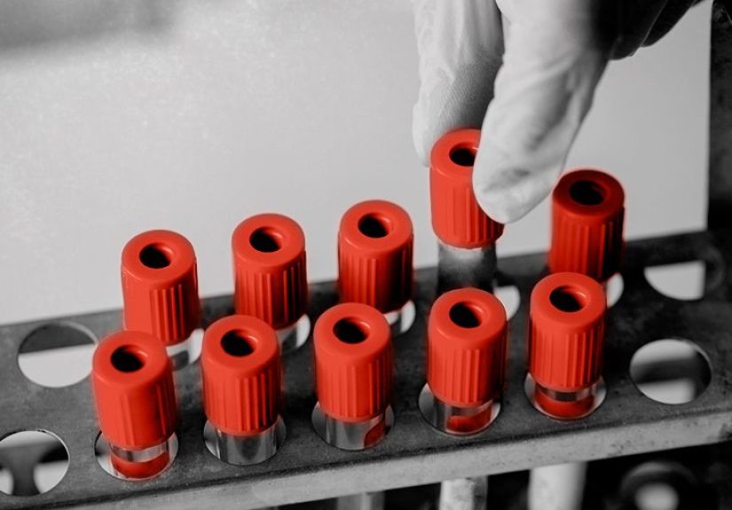 GGT test: Normal ranges, uses, results, and what to expect