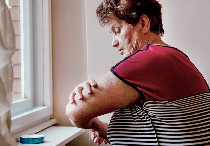 Hives and Parkinson's Disease: Itching, Sweating, Skin Problems