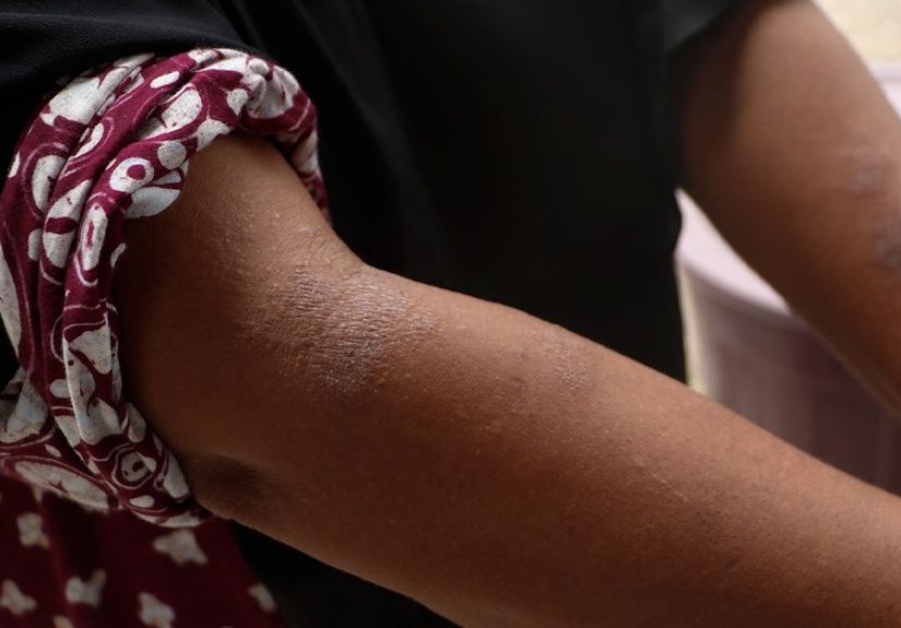 How To Treat Eczema on Dark Skin