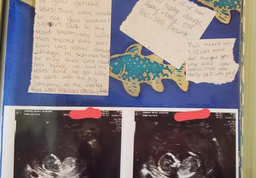 Let’s Talk About Vanishing Twin Syndrome