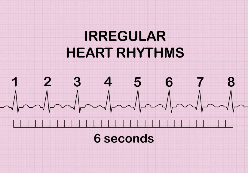 3 Ways to Calculate Heart Rate from ECG