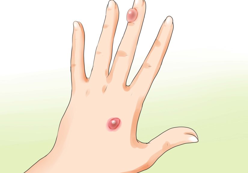 3 Ways to Treat a Blister Burn