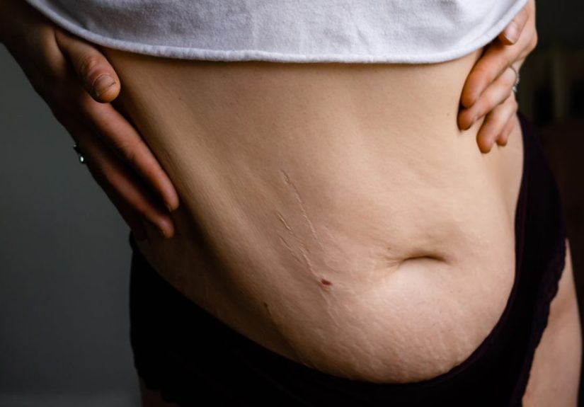 Body Dysmorphia After Losing Weight: How to Manage