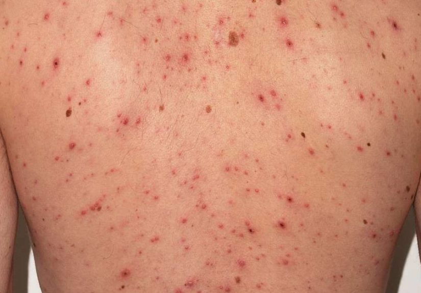 Chickenpox in adults: Symptoms, treatments, and vaccination