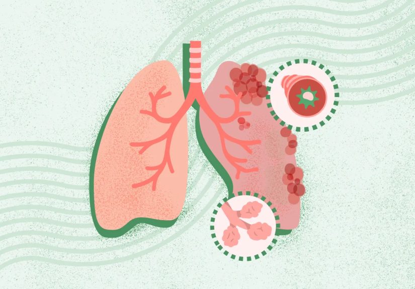COPD: What Are the Symptoms, Causes, and Treatment Options?
