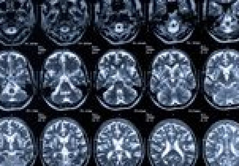Creutzfeldt-Jakob Disease and Mad Cow Disease