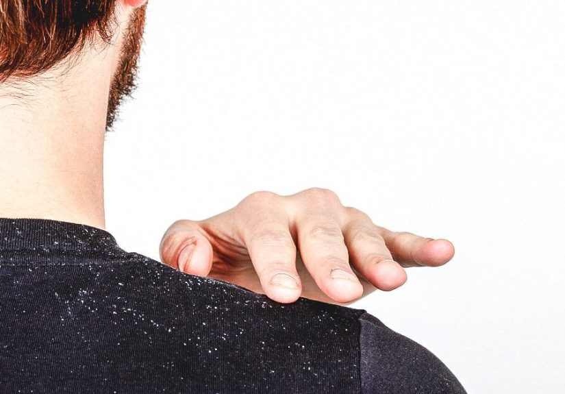 Is Dandruff Contagious? And Other Flaky Questions