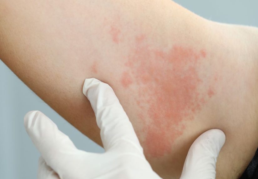 Is Dyshidrotic Eczema Contagious? Risk Factors and Prevention