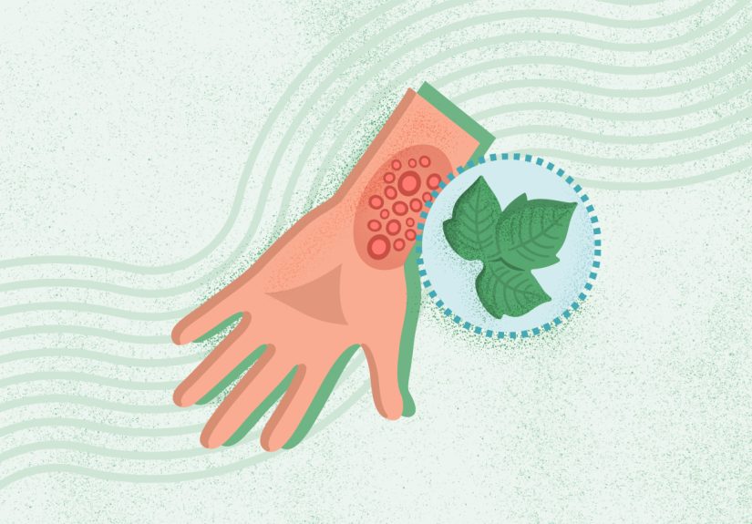 Poison Ivy Symptoms