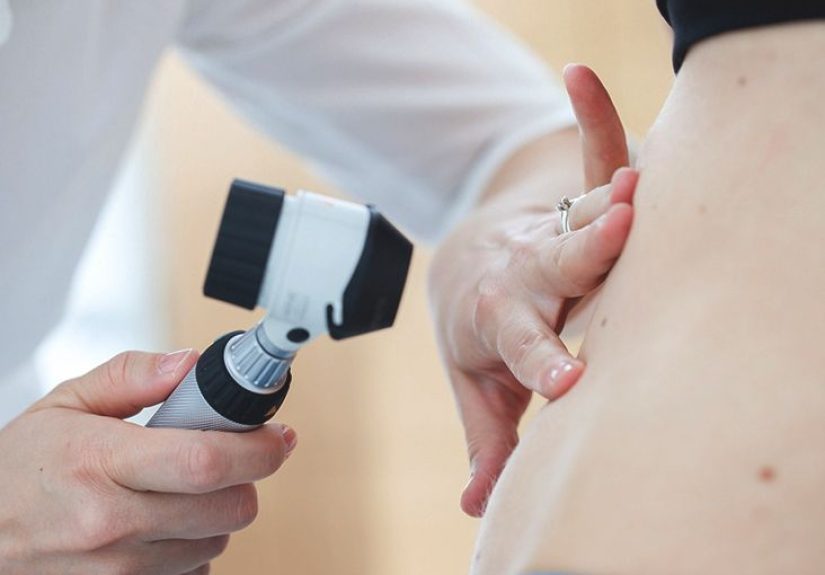 Seborrheic Keratosis vs. Melanoma: Know the Facts