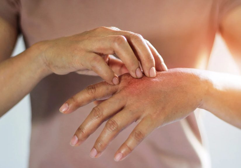 Spotlight: Atopic Dermatitis: What’s New