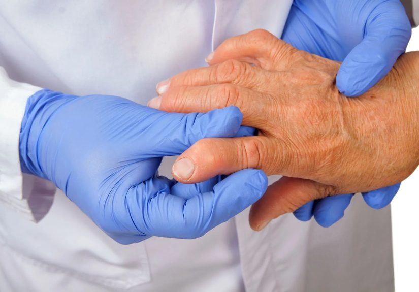 Understanding Rheumatoid Arthritis in Hands and Fingers