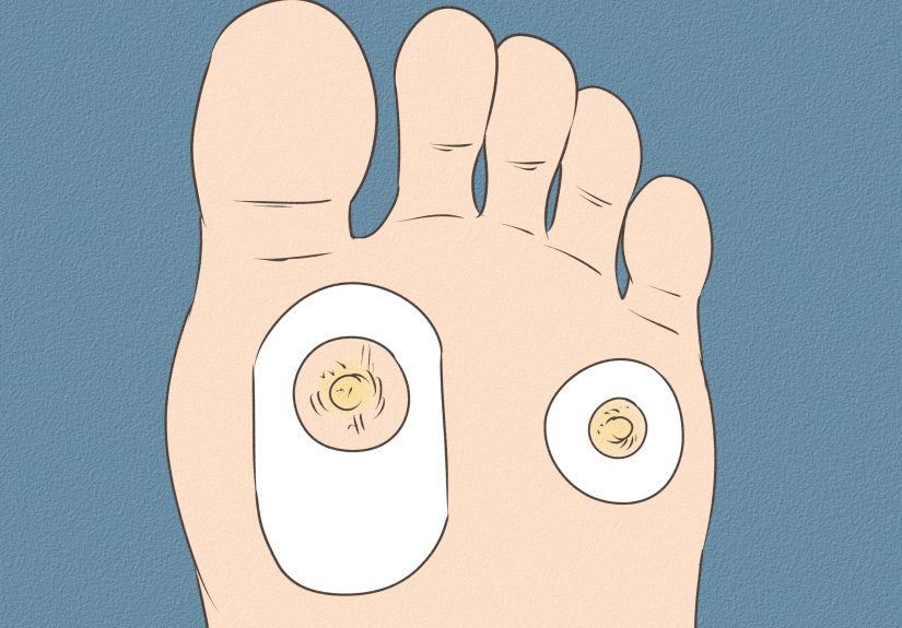 3 Ways to Get Rid of Calluses