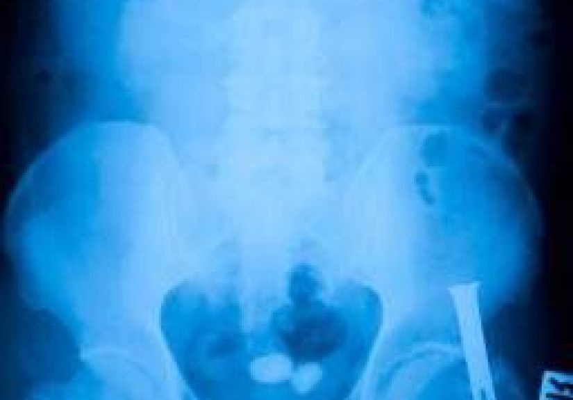 Bladder Stones: Causes, Symptoms, and Treatments