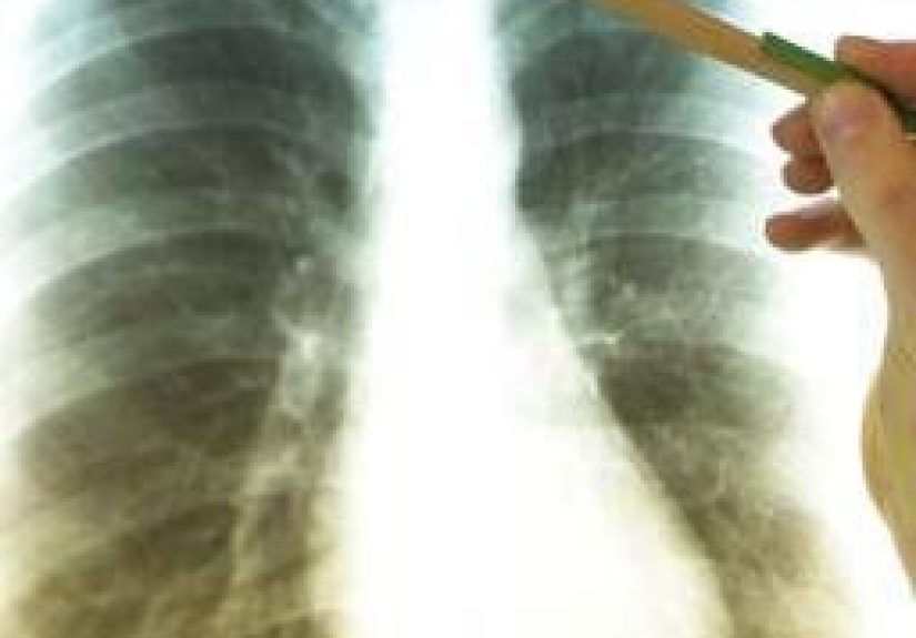 Flail chest: Causes and treatment