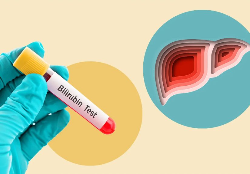 High Bilirubin Levels: Symptoms, Causes, Treatment