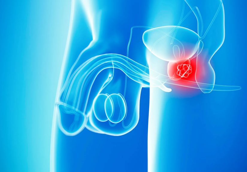 How Long Should Active Surveillance of Prostate Cancer Last?