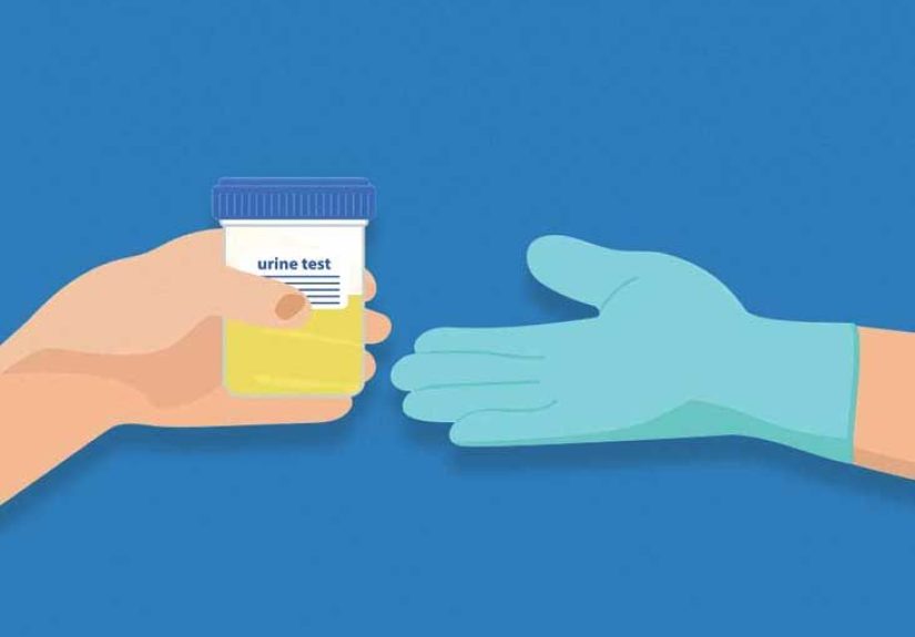 Potassium Urine Test: Causes, Procedure, and Results