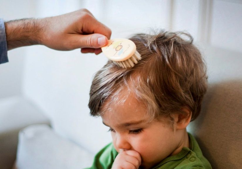 Scalp Yeast Infection: Causes, Symptoms, and Treatments
