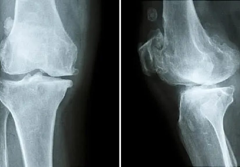 Video on Osteopenia Causes and Treatments