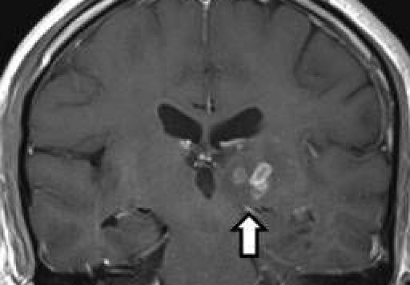A world first: scientists sequence genome of tapeworm removed from man's brain