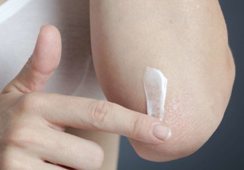 Dermalex for Psoriasis: Effectiveness, Safety, and Side Effects