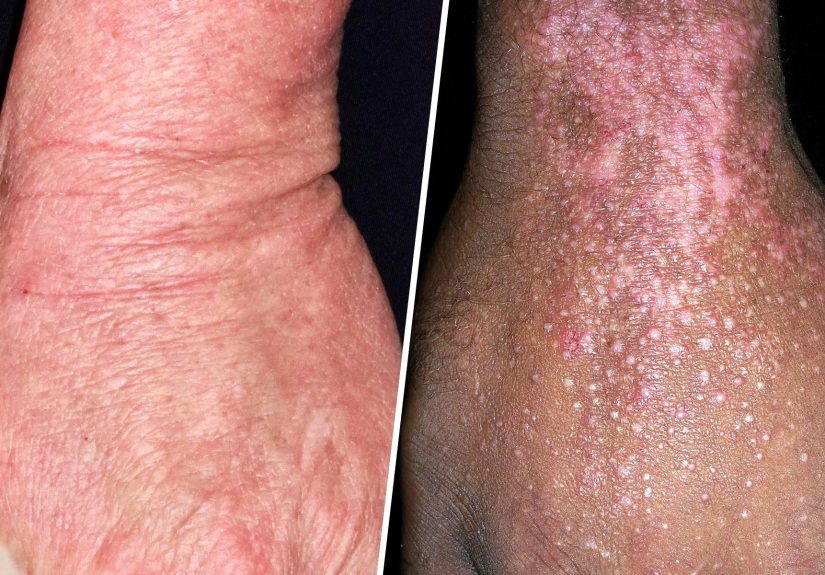 Eczema Symptoms