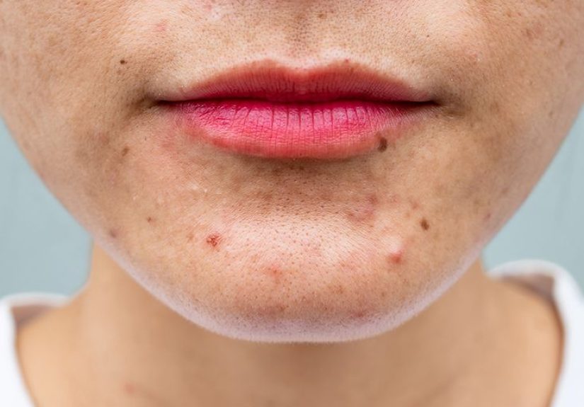 How to Deal with Hormonal Acne as an Adult