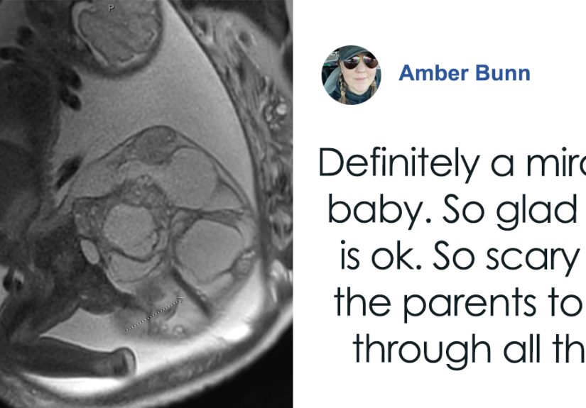 &ldquo;Miracle Angel&rdquo;: Newborn Survives Life-Threatening 4-Lb. Tumor, Mom Candidly Shares Her Story