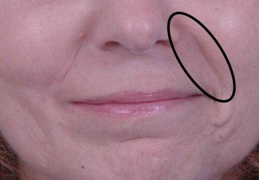 Nasolabial Folds: Causes, Treatment, Exercises, and Prevention