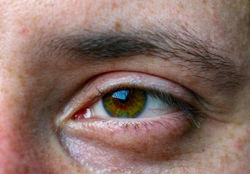 Orbital Emphysema: Can Make Your Eyelid Puffy