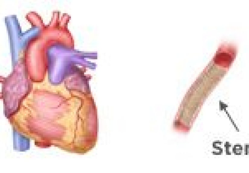 Peripheral Artery Angioplasty and Stent Placement