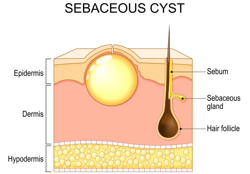 Skin Cyst Treatment: How To Get Rid Of a Skin Cyst