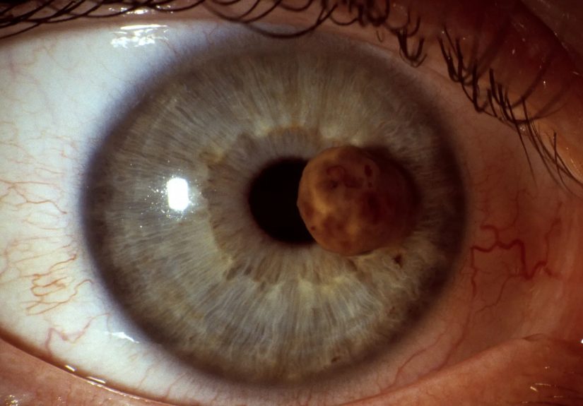 Unexpected Places You Can Get Skin Cancer