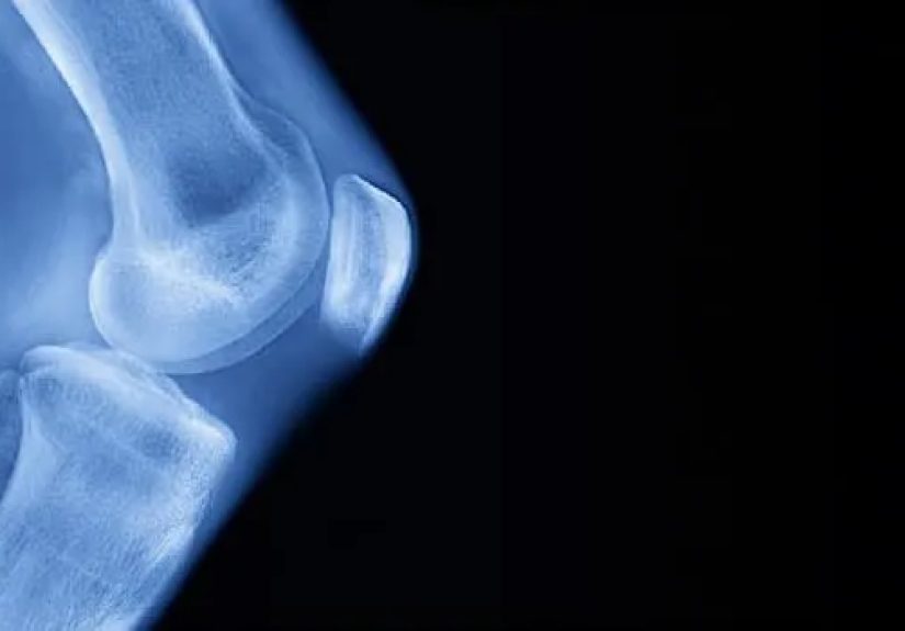 Visual Guide to Understanding Osteoarthritis